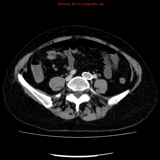 Acute gangrenous cholecystitis (Radiopaedia 10123-10661 Axial C+ portal venous phase 70).jpg