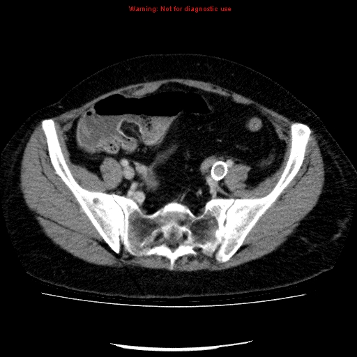 Acute gangrenous cholecystitis (Radiopaedia 10123-10661 Axial C+ portal venous phase 80).jpg