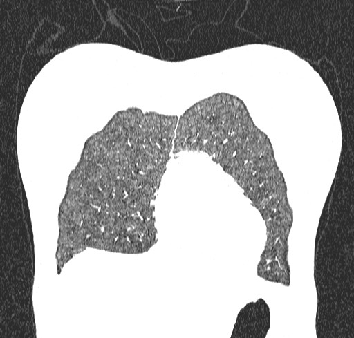 Acute hypersensitivity pneumonitis (Radiopaedia 85293-100870 Coronal lung window 14).jpg