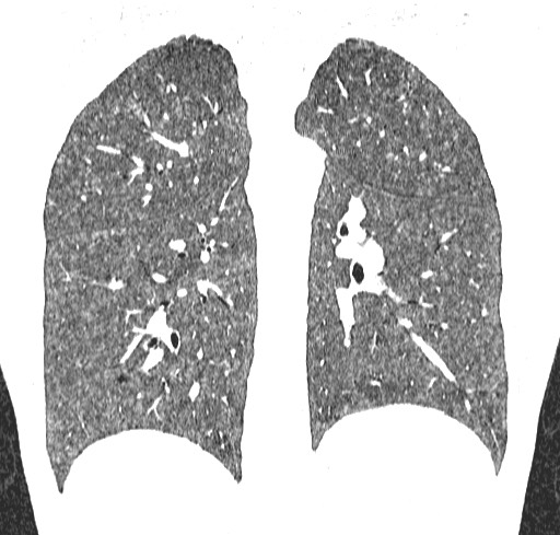 Acute hypersensitivity pneumonitis (Radiopaedia 85293-100870 Coronal lung window 89).jpg