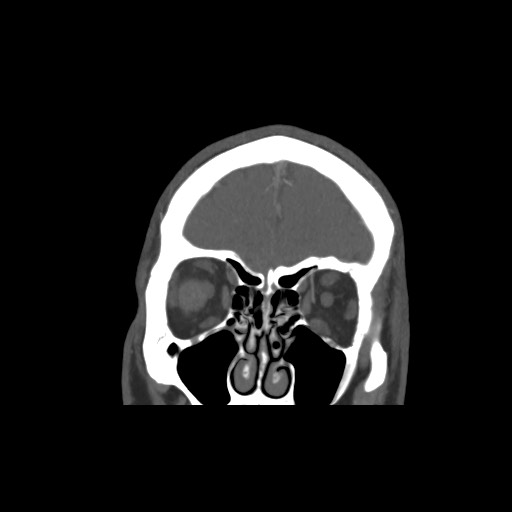Acute internal carotid artery dissection (Radiopaedia 53541-59630 E 11).jpg