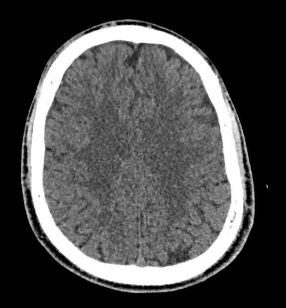 Acute ischemic stroke - posterior circulation territory (Radiopaedia 77670-89881 non-contrast 64).jpg