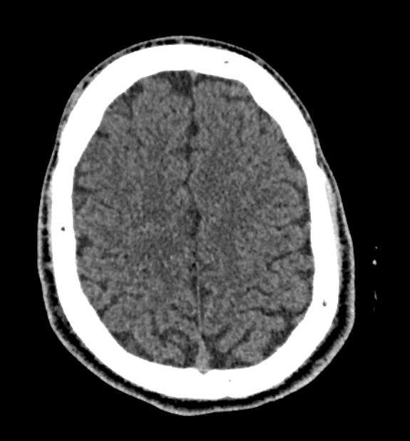 Acute ischemic stroke - posterior circulation territory (Radiopaedia 77670-89881 non-contrast 71).jpg