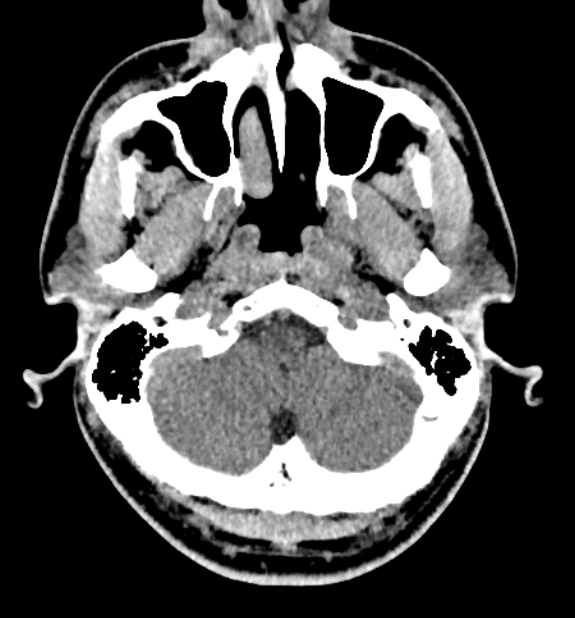 Acute ischemic stroke - posterior circulation territory (Radiopaedia 77670-89881 non-contrast 9).jpg