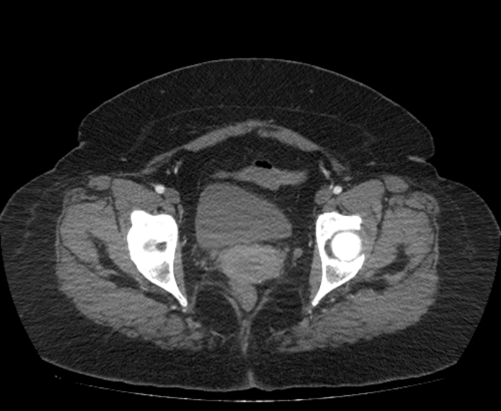 Acute mesenteric ischemia (Radiopaedia 80029-93316 Axial C+ arterial phase 124).jpg