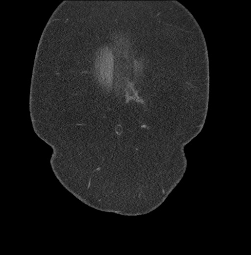 Acute mesenteric venous ischemia (Radiopaedia 46041-50383 Coronal C+ portal venous phase 5).jpg