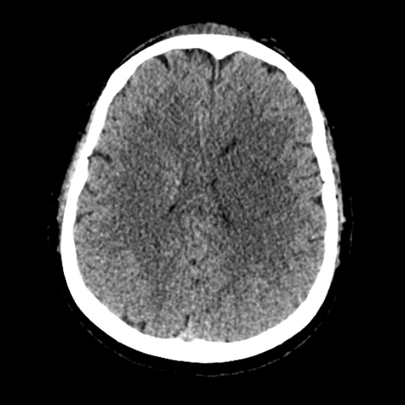 Acute middle cerebral artery territory infarct (Radiopaedia 52380-58283 Axial non-contrast 67).jpg