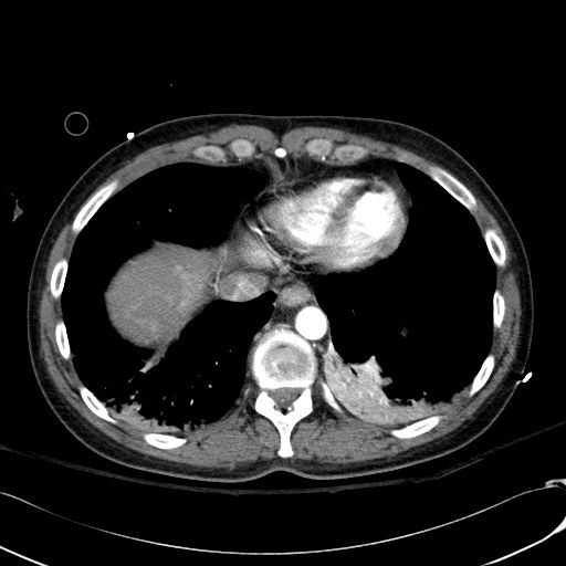 File:Acute myocardial infarction in CT (Radiopaedia 39947-42415 Axial C+ arterial phase 111).jpg