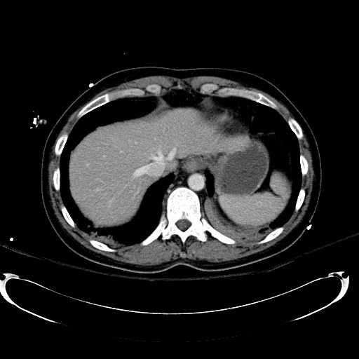 File:Acute myocardial infarction in CT (Radiopaedia 39947-42415 Axial C+ portal venous phase 19).jpg