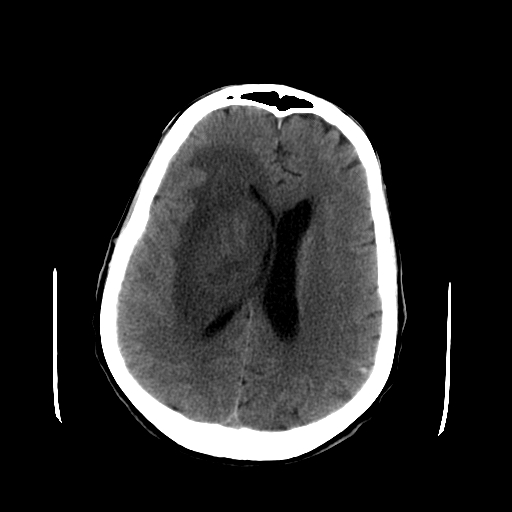 File:Acute necrotizing toxoplasma encephalitis (Radiopaedia 10683-11150 Axial non-contrast 14).jpg
