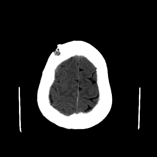 File:Acute necrotizing toxoplasma encephalitis (Radiopaedia 10683-11150 B 6).jpg