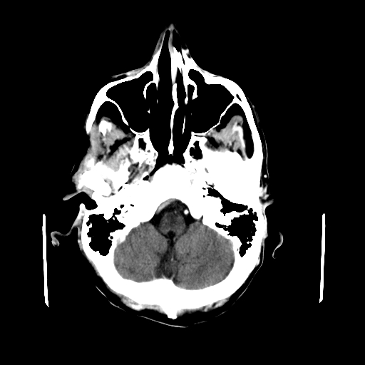 File:Acute necrotizing toxoplasma encephalitis (Radiopaedia 10683-11150 C+ arterial phase 27).jpg