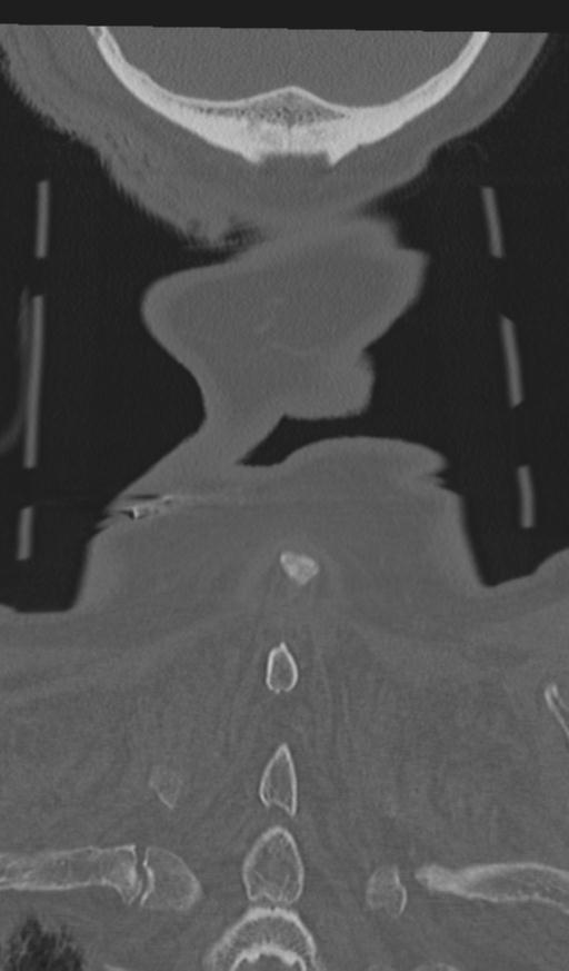 Acute on chronic subdural hematoma and thoracic vertebral injury in a multitrauma patient (Radiopaedia 31698-32619 Coronal bone window 69).jpg