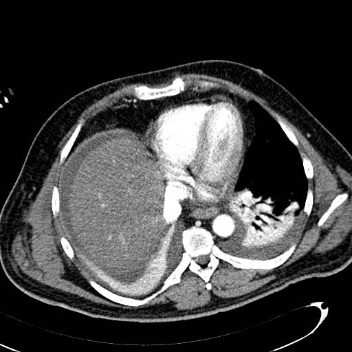 File:Acute pancreatic necrosis (Radiopaedia 13560-13486 Axial C+ portal venous phase 16).jpg