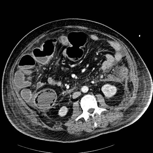 Acute pancreatic necrosis (Radiopaedia 13560-18502 Axial C+ portal venous phase 55).jpg