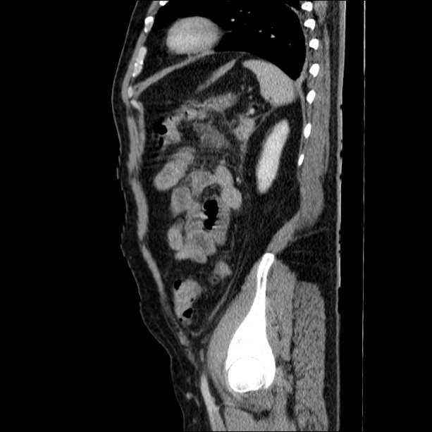 Acute pancreatitis (Radiopaedia 26663-26813 Sagittal C+ portal venous phase 58).jpg