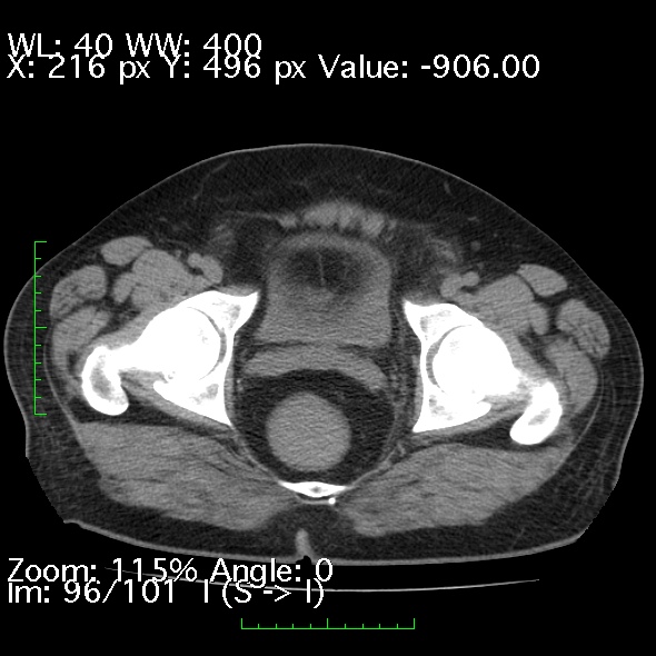 File:Acute pancreatitis (Radiopaedia 34043-35276 Axial non-contrast 96).jpg