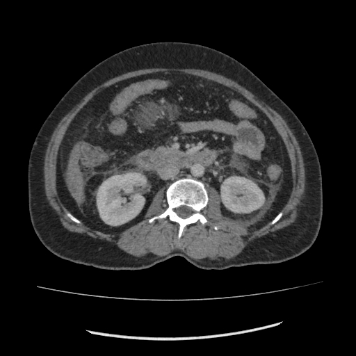 Acute pancreatitis (Radiopaedia 80007-93285 Axial C+ portal venous phase 95).jpg