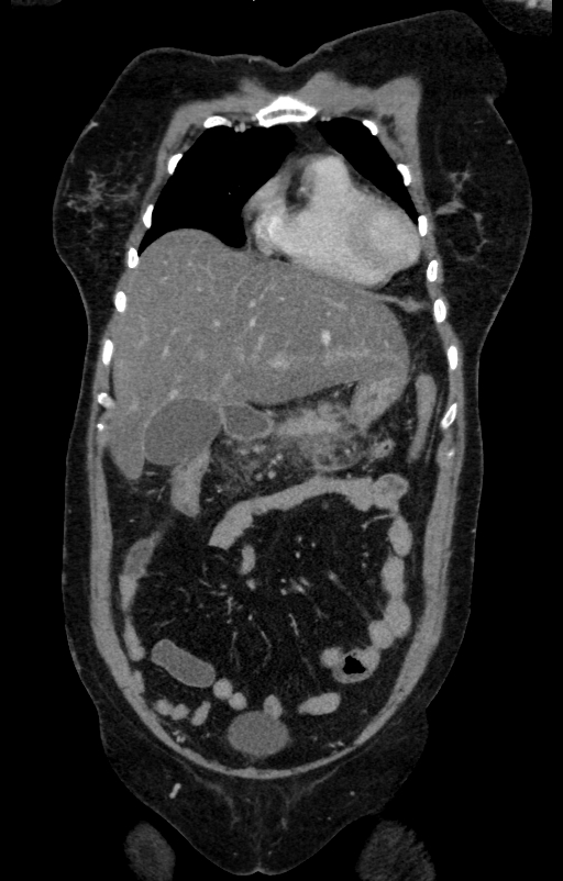 Acute pancreatitis (Radiopaedia 80007-93285 Coronal C+ portal venous phase 25).jpg