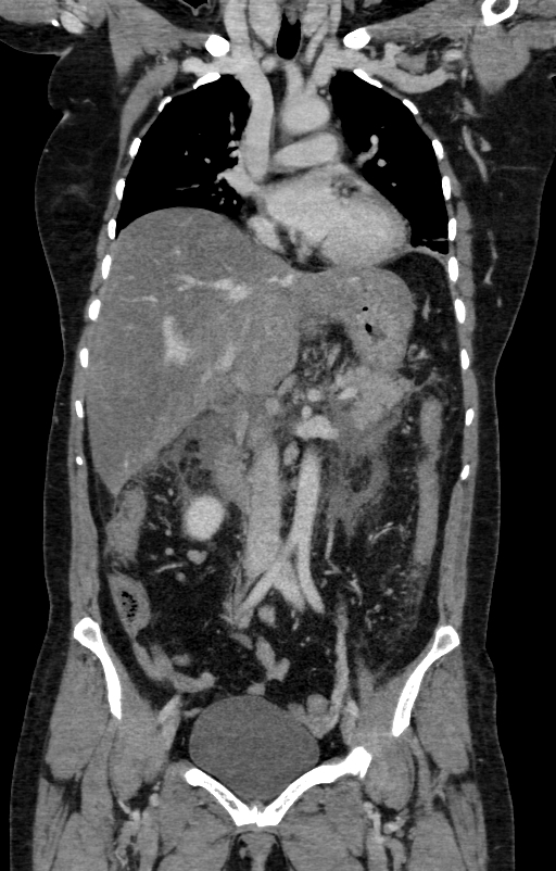 Acute pancreatitis (Radiopaedia 80007-93285 Coronal C+ portal venous phase 50).jpg