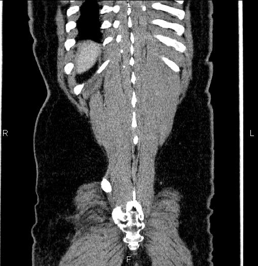 Acute pancreatitis (Radiopaedia 85390-101010 Coronal C+ portal venous phase 68).jpg