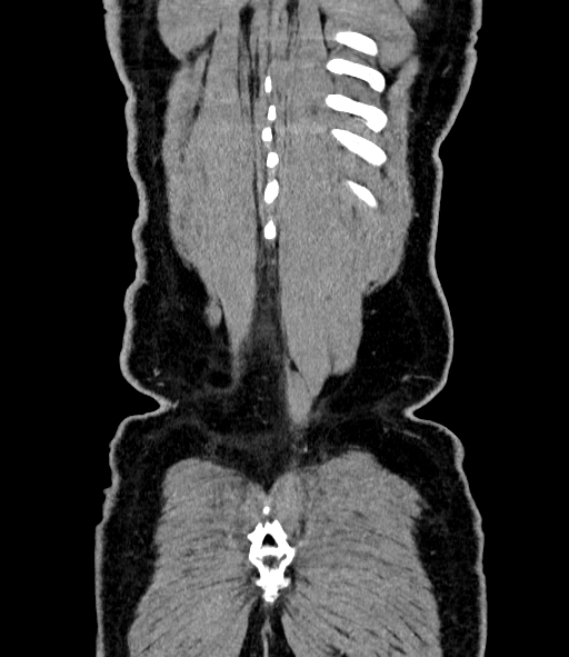 File:Acute pancreatitis (Radiopaedia 87428-103757 Coronal C+ portal venous phase 87).jpg