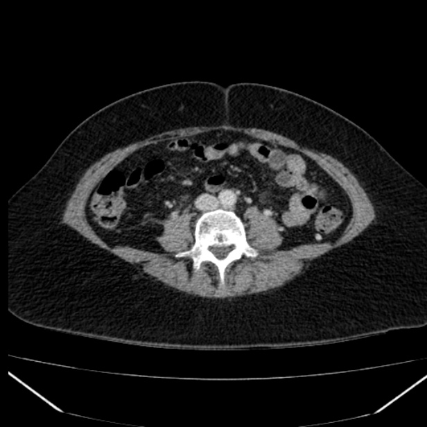 Acute pancreatitis - Balthazar C (Radiopaedia 26569-26714 Axial C+ portal venous phase 60).jpg