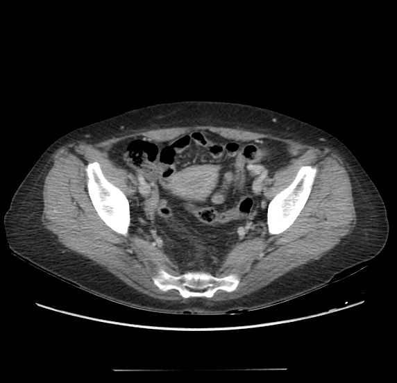 File:Acute pancreatitis - Balthazar E - post ERCP (Radiopaedia 27562-27772 Axial C+ portal venous phase 65).png