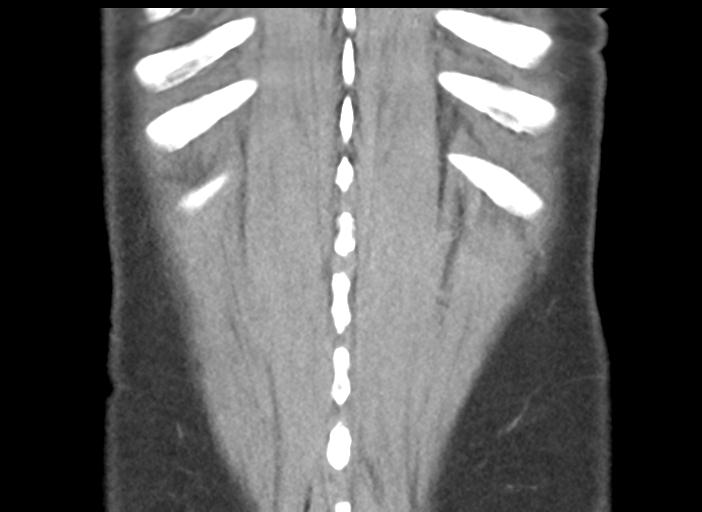 File:Acute pancreatitis and walled-off necrosis (Radiopaedia 29888-30404 Coronal C+ portal venous phase 48).jpg