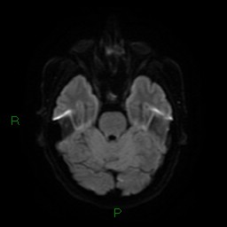 Acute posterior cerebral artery territory infarct (Radiopaedia 79329-92394 Axial DWI 10).jpg