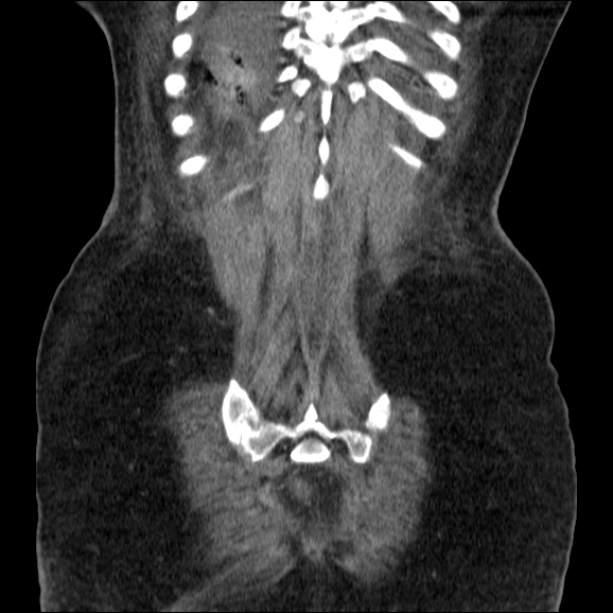 Acute pyelonephritis (Radiopaedia 26584-26729 C+ portal venous phase 65).jpg