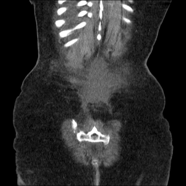 Acute pyelonephritis (Radiopaedia 26584-26729 C+ portal venous phase 68).jpg