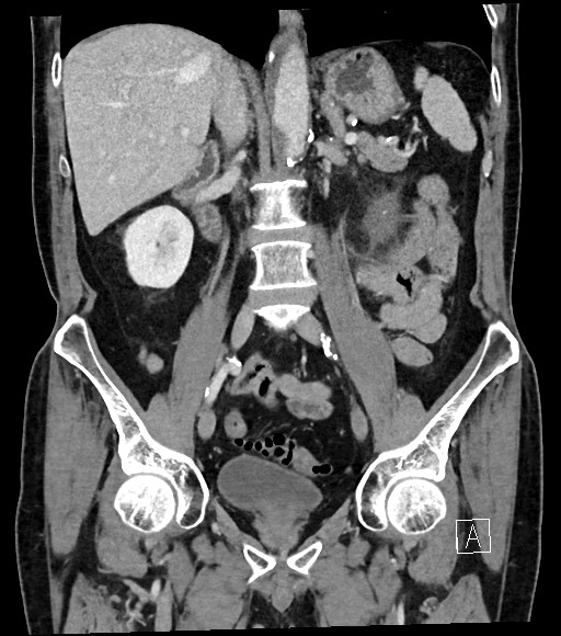 Acute renal infarction (Radiopaedia 59375-66736 Coronal C+ portal venous phase 34).jpg
