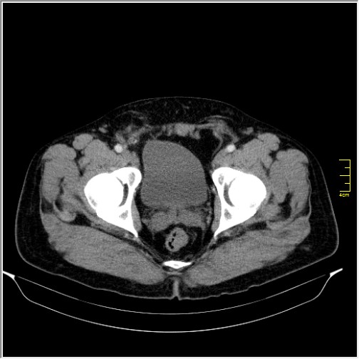 File:Acute right sided diverticulitis (Radiopaedia 65249-74268 Axial C+ portal venous phase 75).JPG