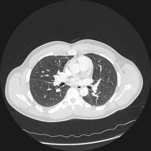 Acute segmental pulmonary emboli and pulmonary infarction (Radiopaedia 62264-70444 Axial lung window 88).jpg