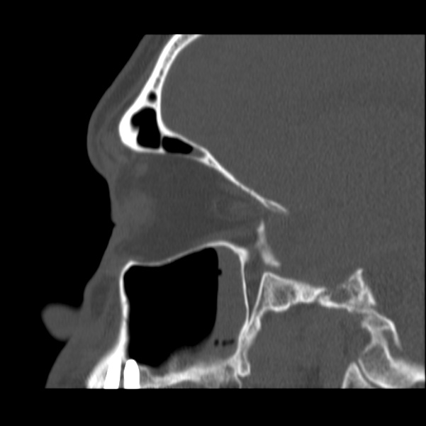 Acute sinusitis (Radiopaedia 23161-23215 Sagittal bone window 43).jpg