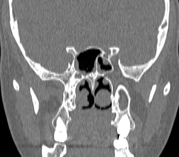 Acute sinusitis (Radiopaedia 40564-43158 Coronal bone window 33).jpg