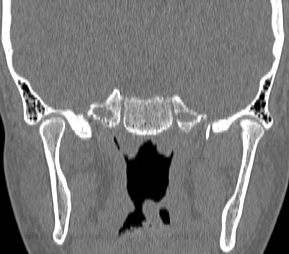 Acute sinusitis (Radiopaedia 40564-43158 Coronal bone window 49).jpg