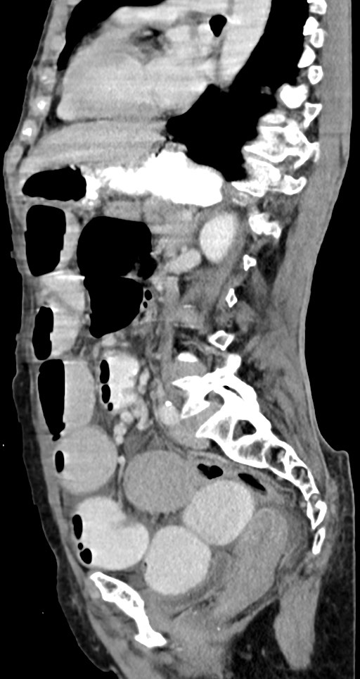 Acute small bowel (ileal) volvulus (Radiopaedia 71740-82139 Sagittal C+ portal venous phase 75).jpg