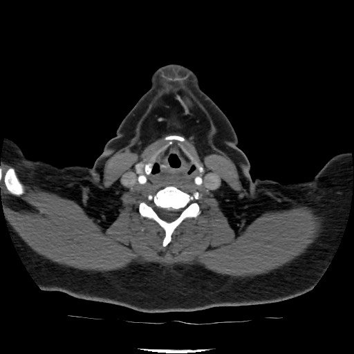 Acute subarachnoid hemorrhage and accessory anterior cerebral artery (Radiopaedia 69231-79009 Axial C+ arterial phase 44).jpg