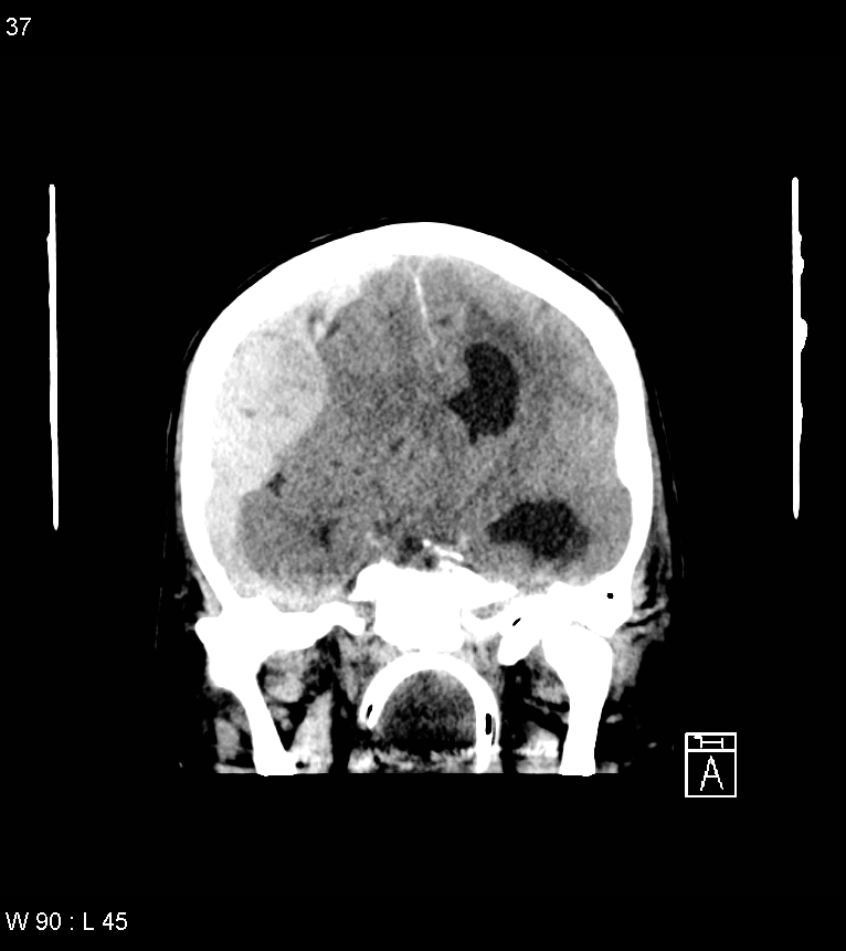 Acute subdural hematoma with myelofibrosis (Radiopaedia 52582-58494 Coronal non-contrast 28).jpg