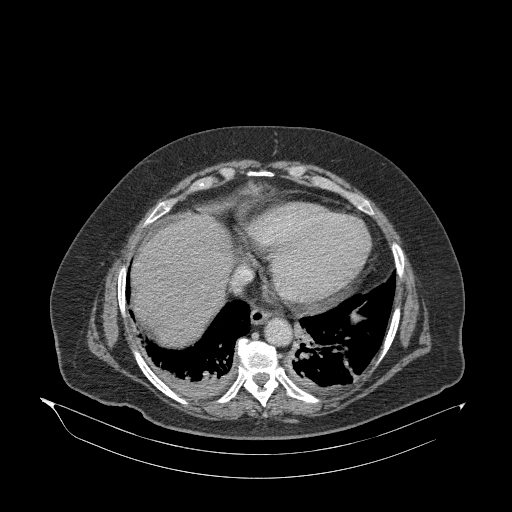 File:Acute superior mesenteric artery occlusion (Radiopaedia 51288-56960 Axial C+ portal venous phase 8).jpg