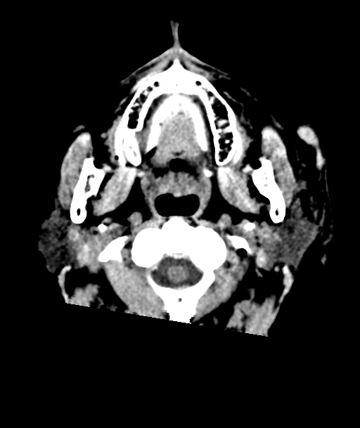 Acute traumatic subdural hematoma (Radiopaedia 82921-97257 Axial non-contrast 65).jpg
