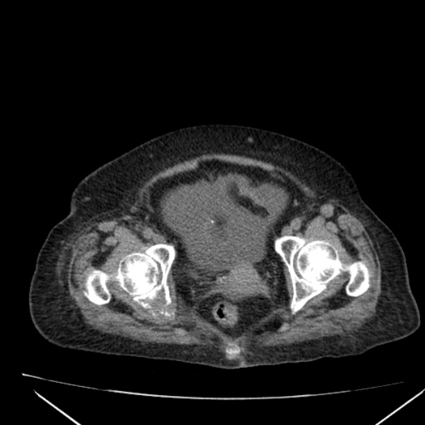 Acute tubular necrosis (Radiopaedia 28077-28334 Axial non-contrast 64).jpg