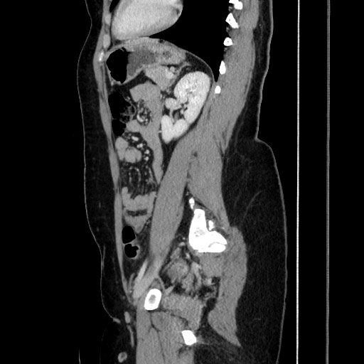 Acute uncomplicated appendicitis (Radiopaedia 73704-84499 Sagittal C+ portal venous phase 135).jpg