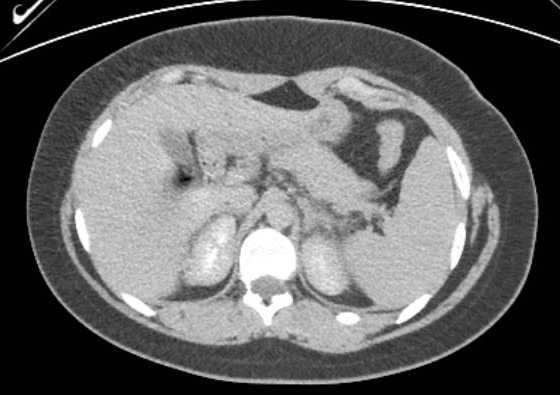 Acute unilateral nonhemorrhagic adrenal infarction (Radiopaedia 67560-76957 Axial renal excretory phase 28).jpg