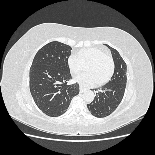 Adenocarcinoma in situ of lung (Radiopaedia 38685-40829 B 140).png