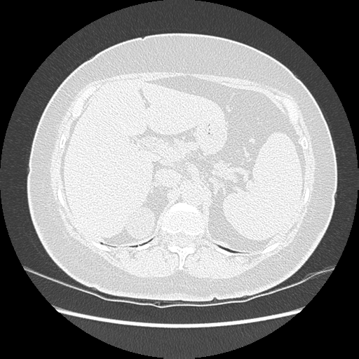 Adenocarcinoma in situ of lung (Radiopaedia 38685-40829 B 220).png