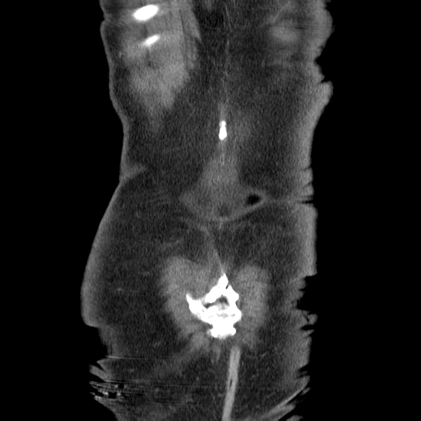 Adenocarcinoma of colon with entero-colic fistula (Radiopaedia 22832-22852 Coronal C+ portal venous phase 51).jpg