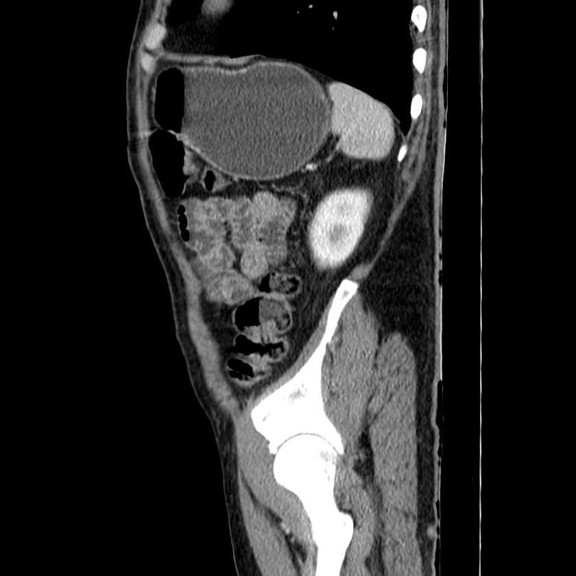 Adenocarcinoma of colon with entero-colic fistula (Radiopaedia 22832-22852 Sagittal C+ portal venous phase 53).jpg
